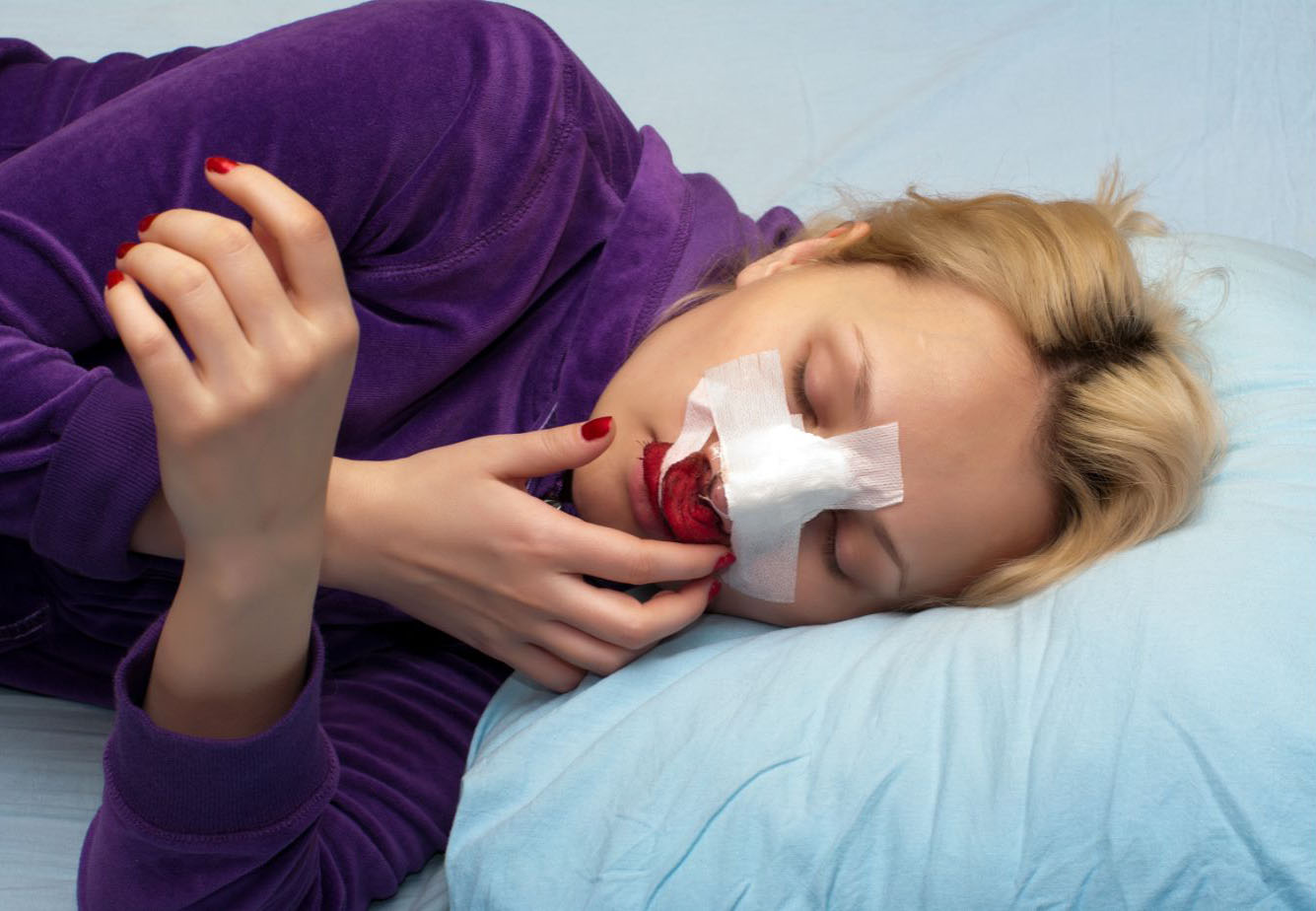 Rinoplastie - Recuperare
