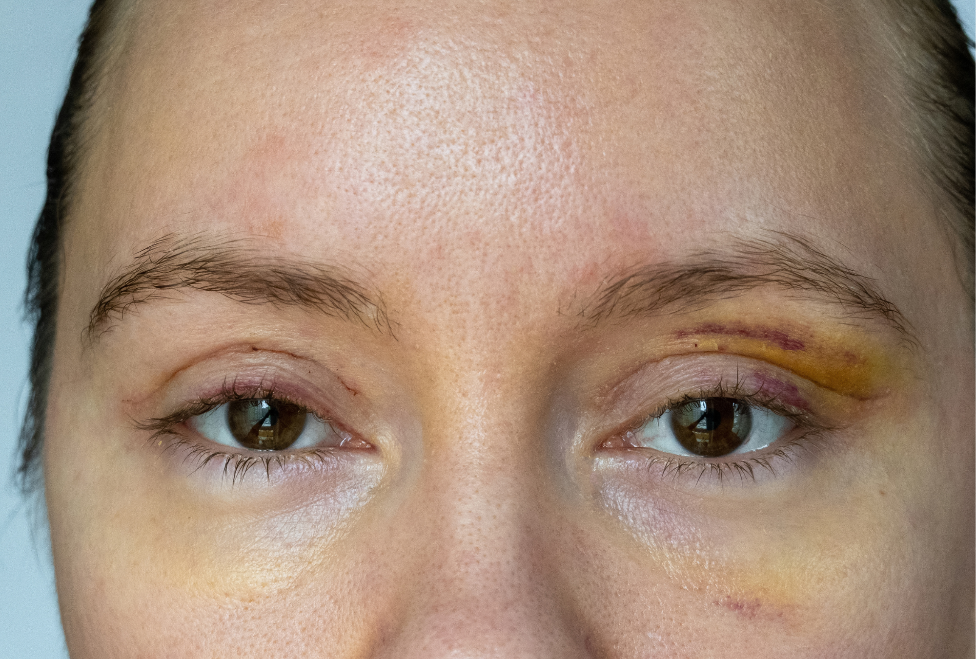 Blefaroplastia